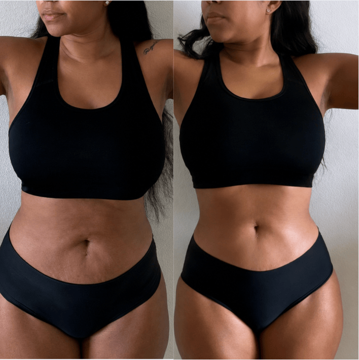 Stomach before and after, before on the left