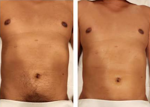 Chest hair before and after