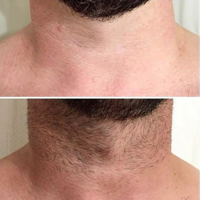 Neck hair before and after