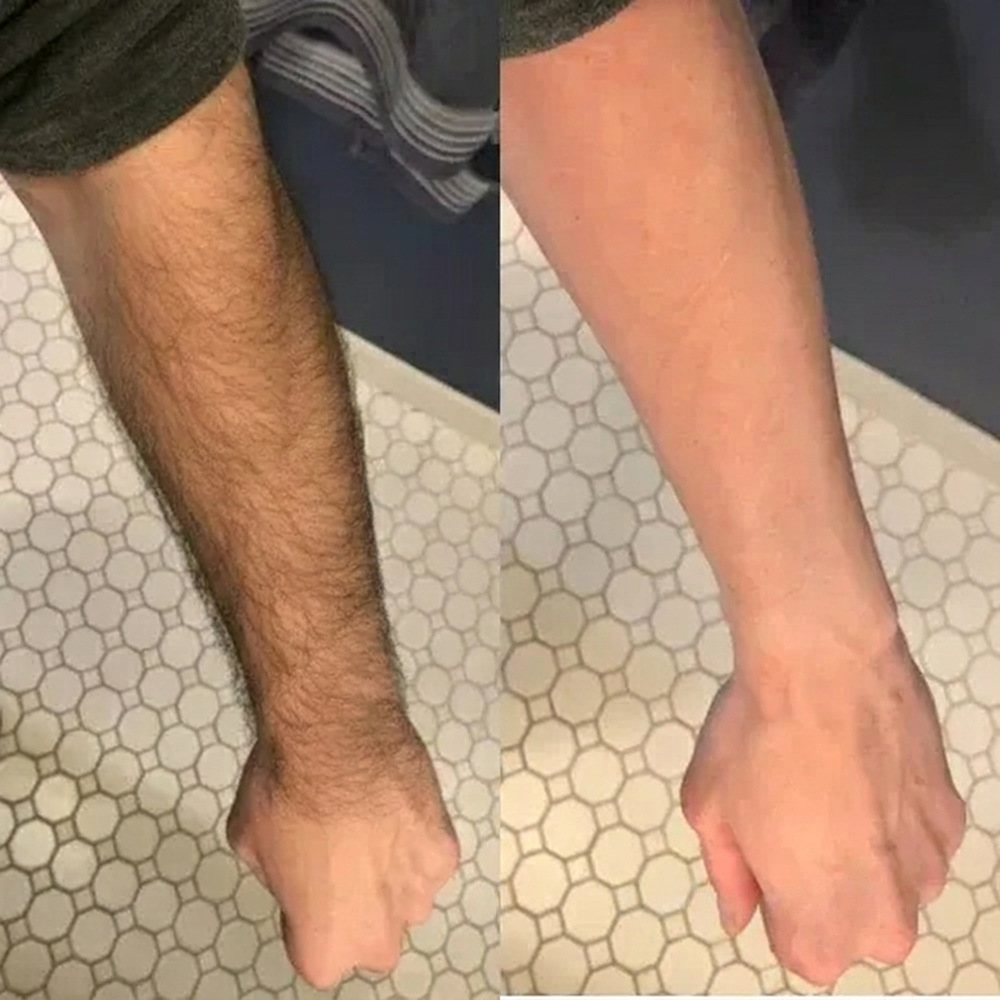 Leg hair removal before and after